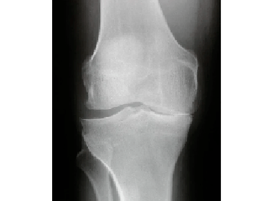 Diagnosis of osteoarthritis of the knee joint