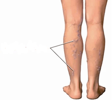 The consequences of knee osteoarthritis