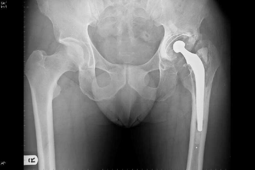 Coksarrosis