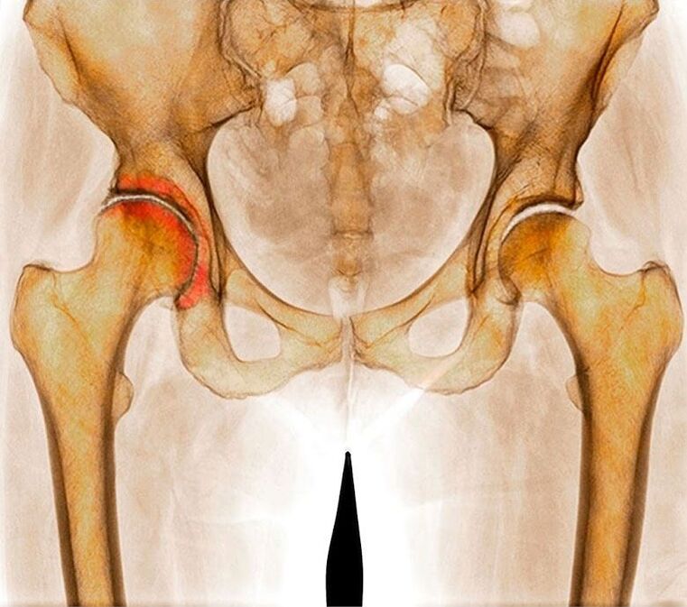 Hip joint osteoarthritis
