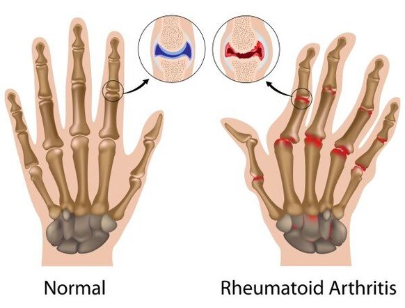 Fingers without pathology and rheumatoid arthritis