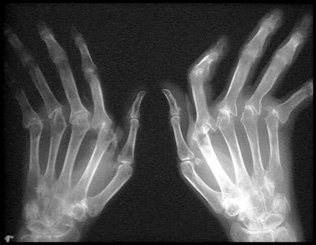 X -Ray of the hands affected by osteoarthritis