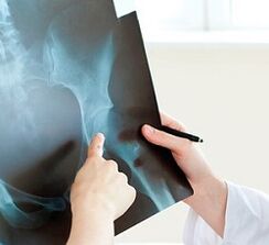 How to treat the osteoarthritis of the hip joint