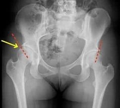 Methods for the treatment of the osteoarthritis of the hip joint