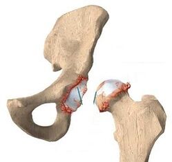 The reasons for the development of the osteoarthritis of the hip joint