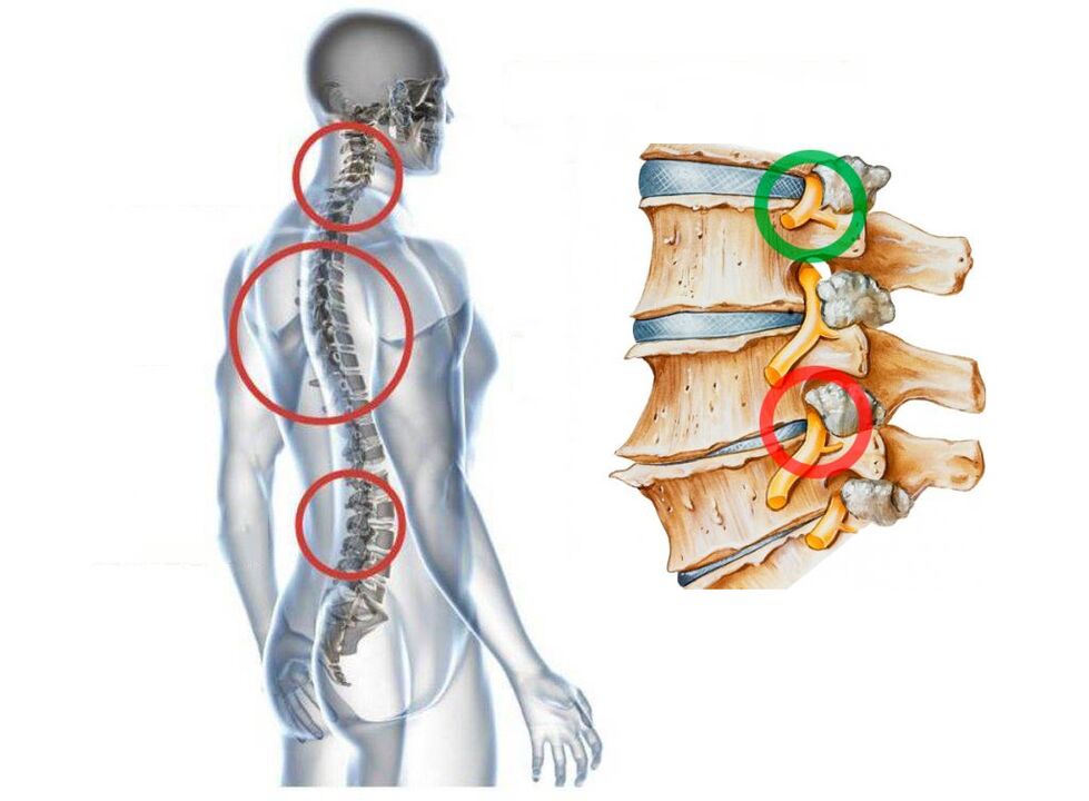 How do you see the cervical osteochondrosis of the vertebrae