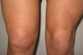 Inflammation in the knee joint with arthritis and osteoarthritis.