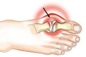 Joint damage due to arthritis and osteoarthritis.