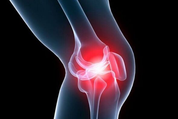 osteoarthritis of the knee joint
