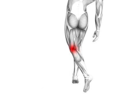 Osteoarthritis of the knee joint.