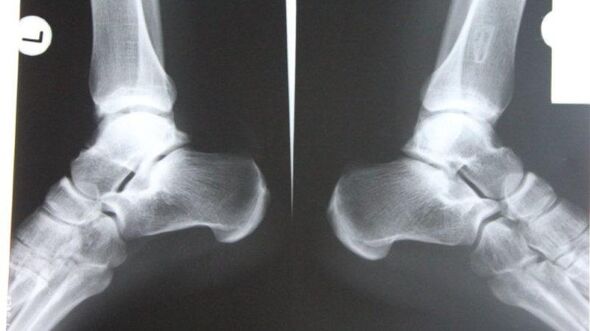 Diagnosis of ankle osteoarthritis by x-ray. 