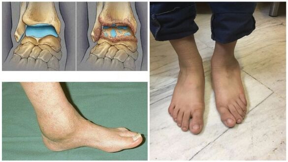 Swelling and deformation of the ankle joint due to osteoarthritis. 