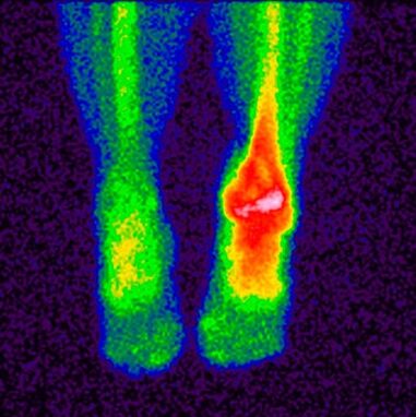 The differential diagnosis method for crusarthrosis is scintigraphy. 